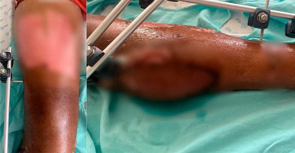 Paciente em Campo Grande corre risco de amputação por demora em cirurgia