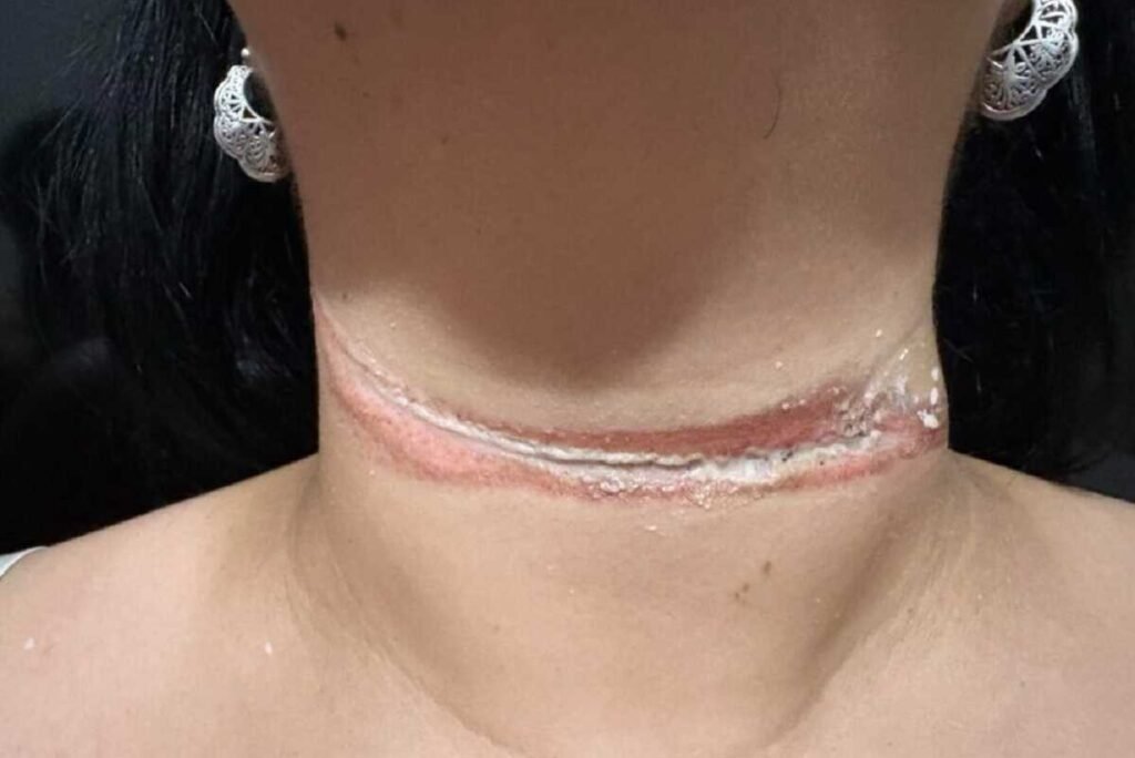 Professora escapa de enforcamento por fio solto em Três Lagoas