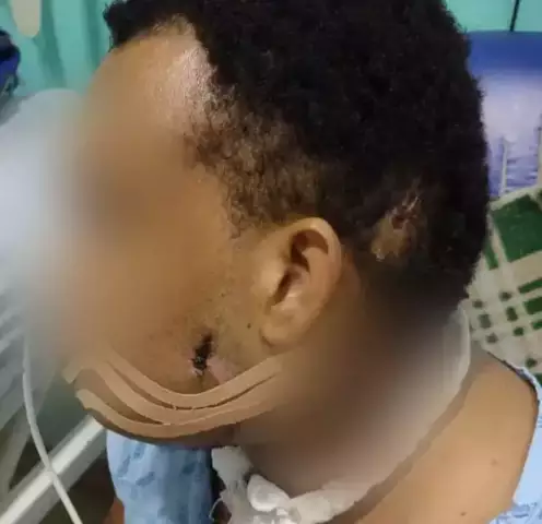 Pessoa com ferimentos no rosto e pescoço em ambiente hospitalar.