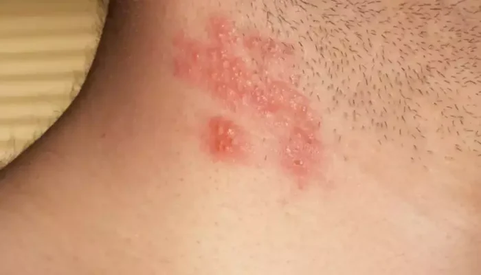 Lesões de herpes zoster na pele de rapaz (Foto: John Pozniak/Wikimedia Commons/CC BY-SA 3.0)