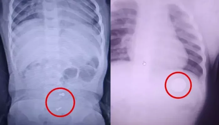 Raio-x mostra moeda e parafusos dentro do estômago de Anthony (Foto: Direto das Ruas)