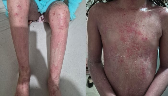 Criança com dermatite — Foto: Criança com dermatite (Foto: Leitor Midiamax)