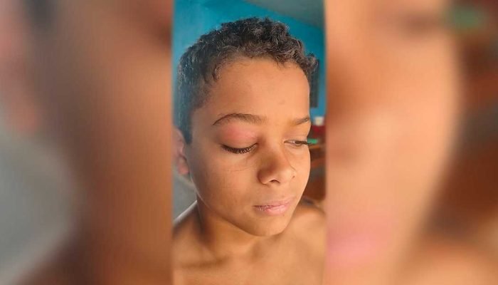 Criança de 11 anos em Sidrolândia precisa de cirurgia urgente para remover tumor no olho