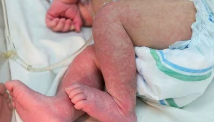 Bebê com chikungunya – imagem ilustrativa. — Foto: Bebê com chikungunya – imagem