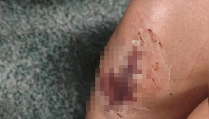 Foto: 1 de 1 Ferida no joelho - Foto: Reprodução / @bastiaonoticias