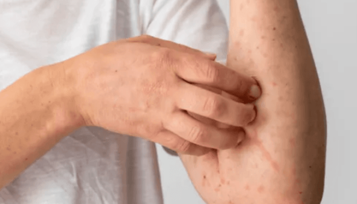 Foto: Mpox | Reprodução/Freepik