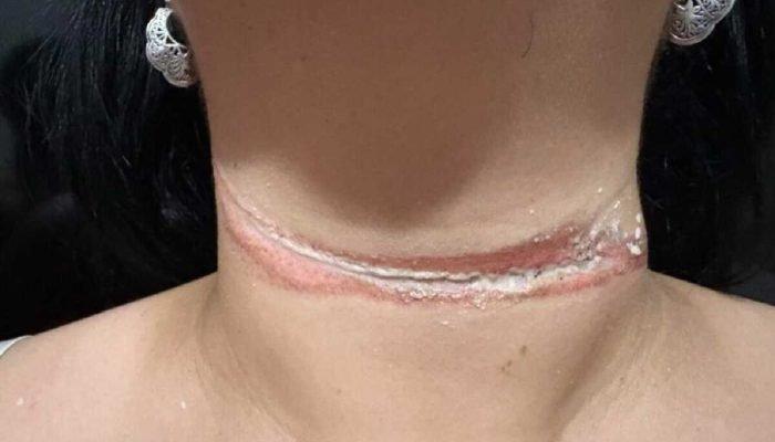 Professora escapa de enforcamento por fio solto em Três Lagoas