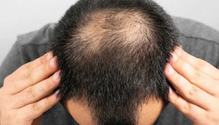 Estudo associa medicamento para calvície a riscos de depressão e suicídio