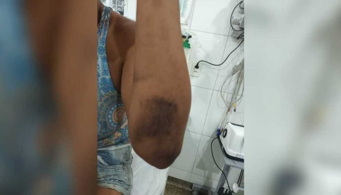 Homem queima namorada com ferro após ser flagrado furtando remédios