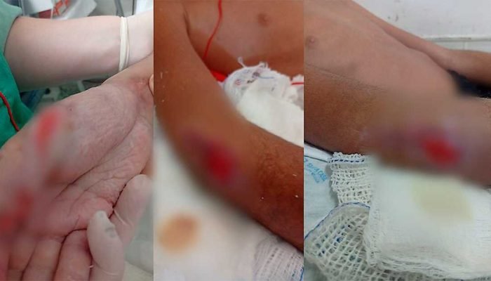 Após seis cirurgias, menino aguarda alta na Santa Casa, em Campo Grande