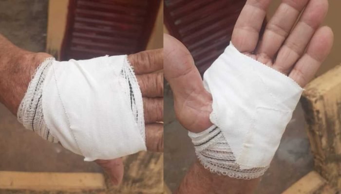 Idosa sai de UPA em Campo Grande sem sutura por falta de material