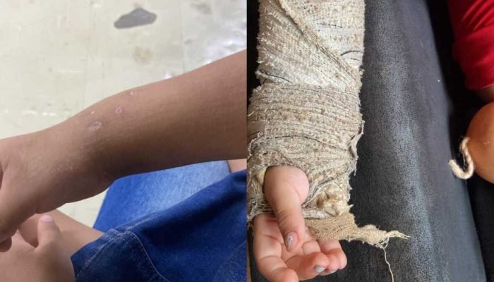 Menina de 3 anos espera mais de 45 dias para retirar pinos do braço após cirurgia na Santa Casa