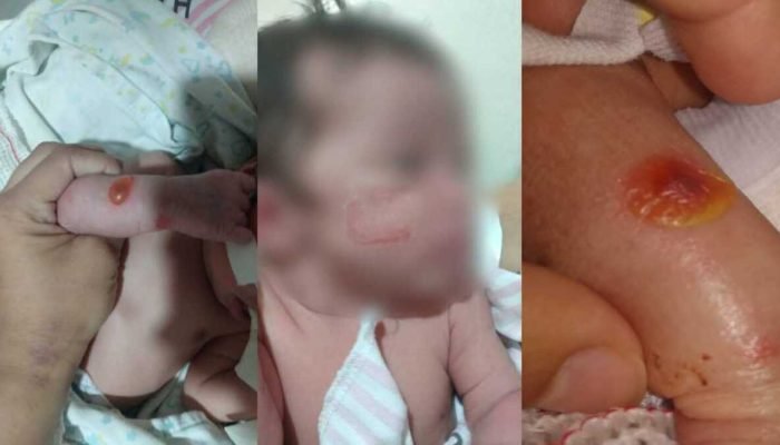 Mãe denuncia negligência e queimaduras em parto no Hospital Regional de Campo Grande