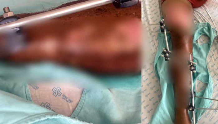 Homem aguarda há mais de um mês por cirurgia após acidente de moto
