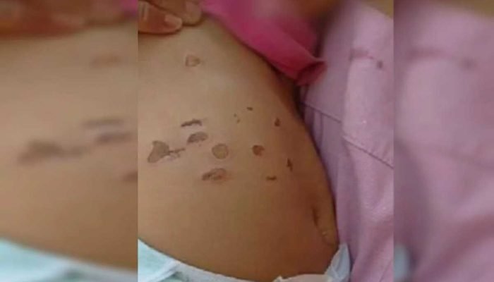 Bebê de 10 meses é hospitalizada com queimaduras de cigarro Bebê de 10 meses é hospitalizada com queimaduras de cigarro