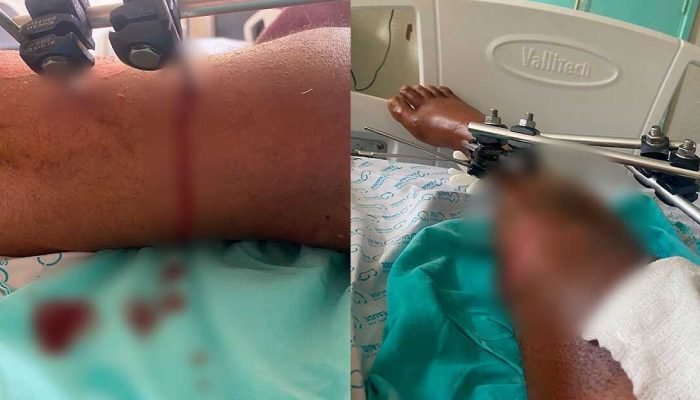 Paciente com fraturas graves é pressionado a deixar Santa Casa mesmo sem condições e cirurgia