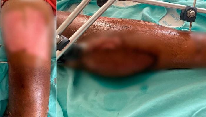 Paciente em Campo Grande corre risco de amputação por demora em cirurgia